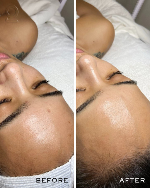 Oxygen CO2 Facial Before After